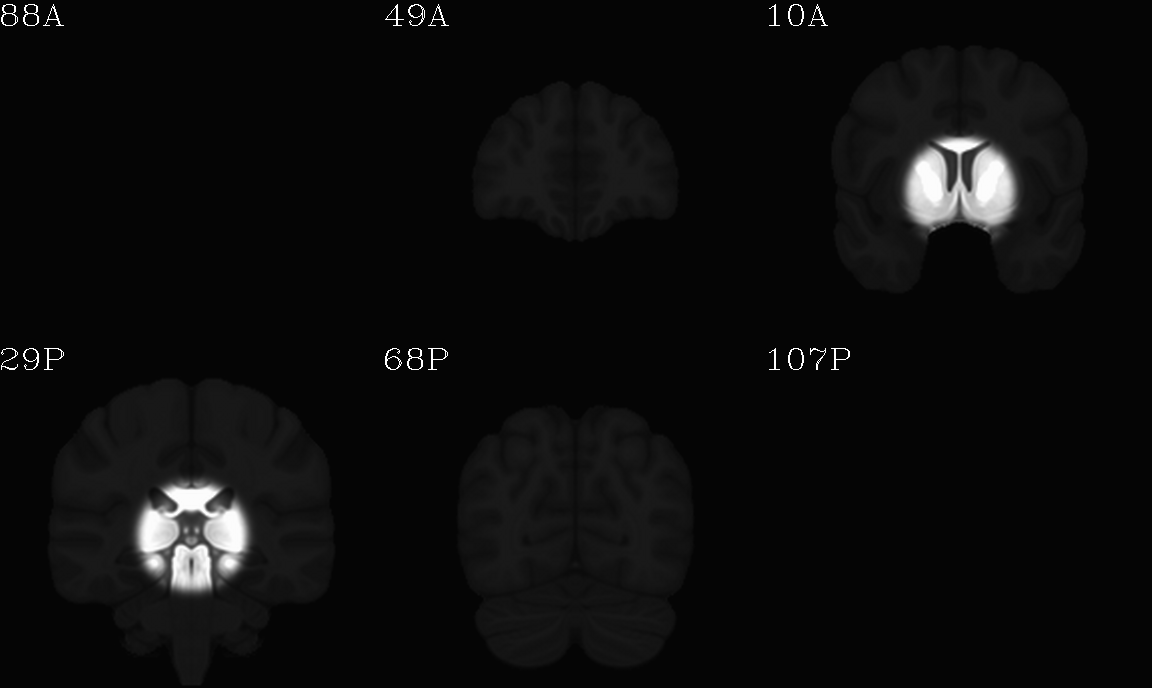 ../../_images/IMG_mni_icbm152_t1_tal_nlin_sym_09a_MSKD_ACPCE_wtell.cor.png