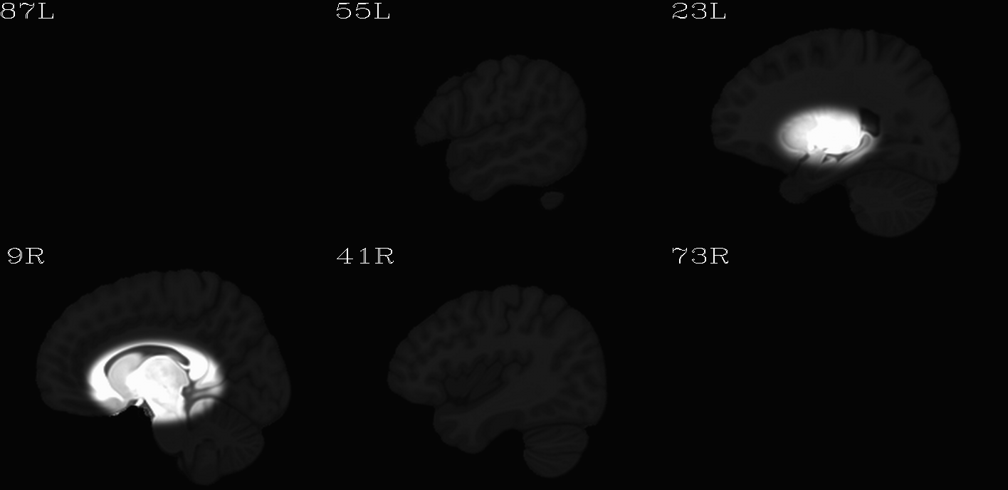 ../../_images/IMG_mni_icbm152_t1_tal_nlin_sym_09a_MSKD_ACPCE_wtell.sag.png