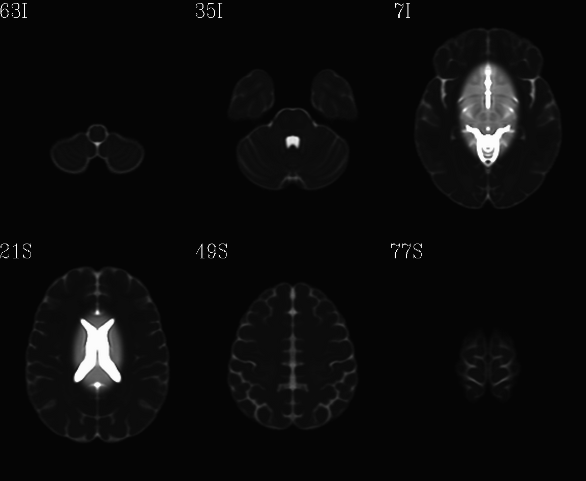 ../../_images/IMG_mni_icbm152_t2_relx_tal_nlin_sym_09a_ACPCE_wtell.axi.png