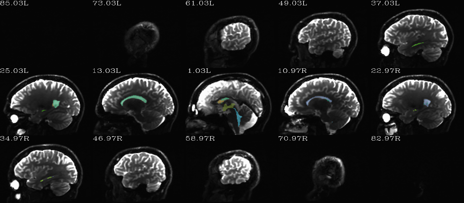 ../../_images/indt__qc_aparc.a2009s%2Baseg_REN_vent.sag.png