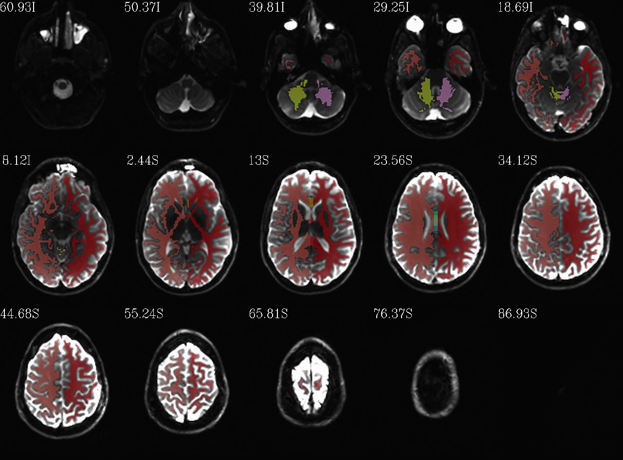 ../../_images/indt__qc_aparc.a2009s%2Baseg_REN_wmat.axi.png